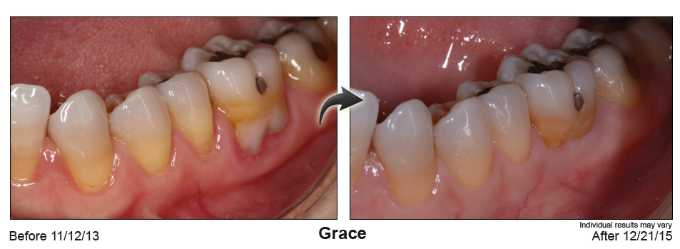 fix gum recession Searcy Arkansas