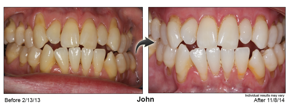 Searcy Arkansas gum recession