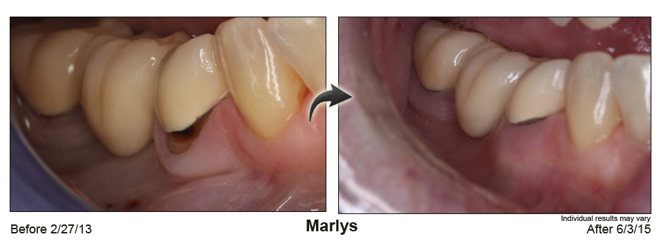 fix receding gums Searcy Arkansas