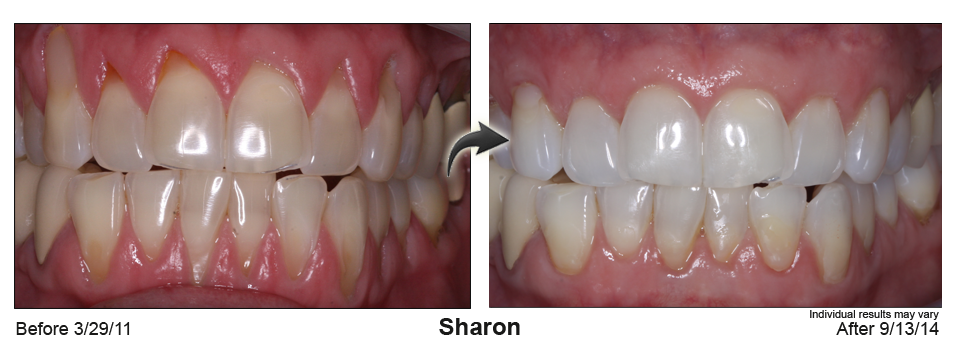 gum recession treatment Searcy Arkansas